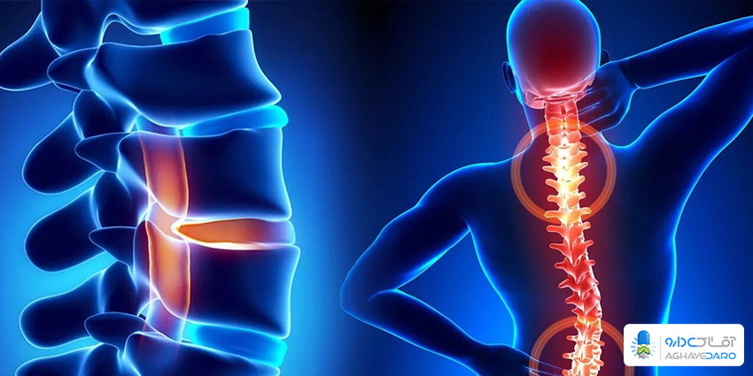 لوردوز یا گودی کمر
