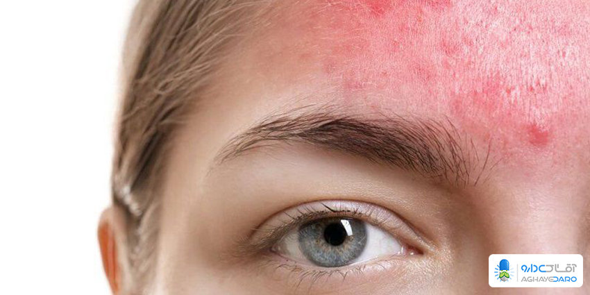 راش پوستی و یا بثورات جلدی چیست؟