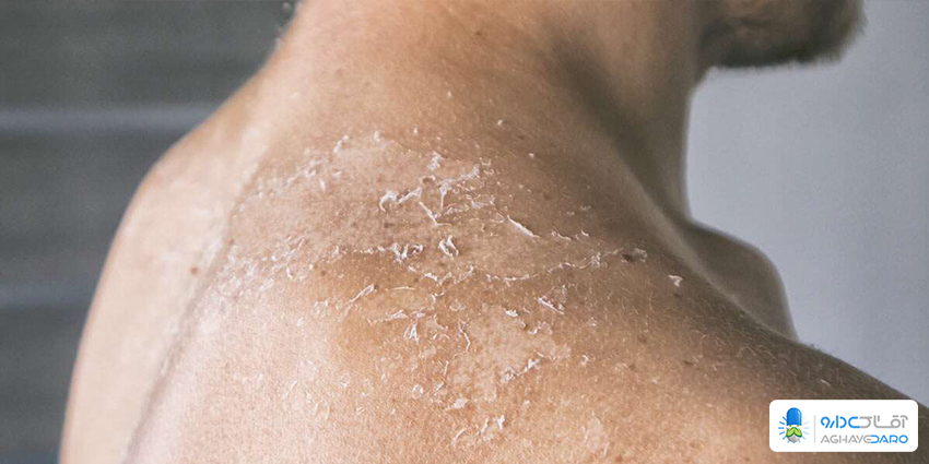 بررسی انواع عفونت‌های قارچی پوست