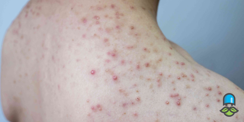 کپسول کلیندامایسین؛ از بین برنده عفونت یا دشمن معده؟ - تصویر 3