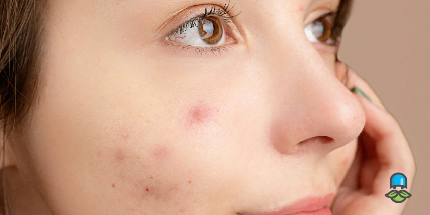 چگونه یک رژیم غذایی ضد جوش داشته باشیم؟