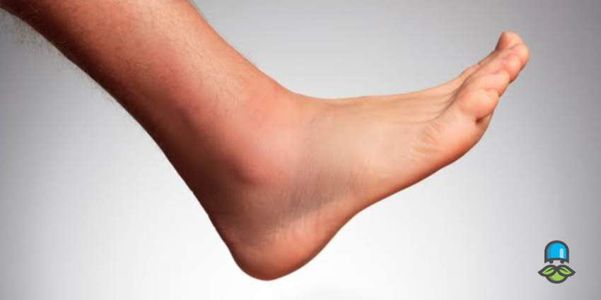 نکات مهم برای پیشگیری از تورم روی مچ پا