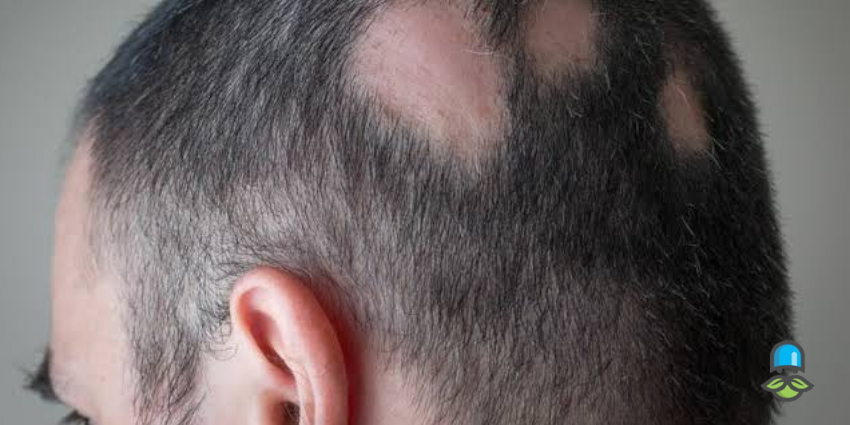 آلوپسی آره آتا چیست و چرا به وجود می‌آید؟