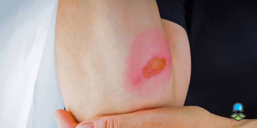 کدام اعضای بدن در معرض ابتلا به زخم بستر هستند؟