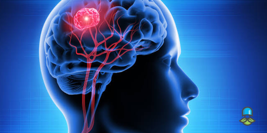منظور از متاستاز مغزی چیست؟