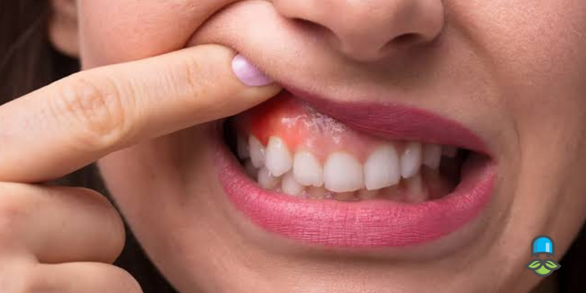 چگونه می‌توان از عفونت لثه پیشگیری کرد؟