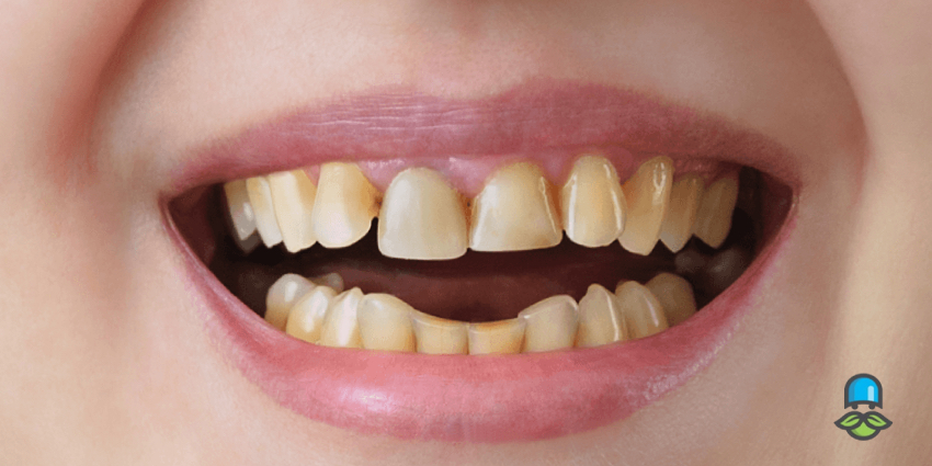 برای جلوگیری از پوسیدگی دندان چه کنیم؟
